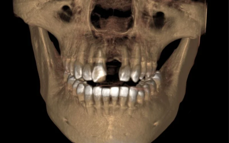 Sirona 高解析3D電腦斷層掃描影像範例