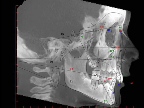 Cephalometric Tracing 1