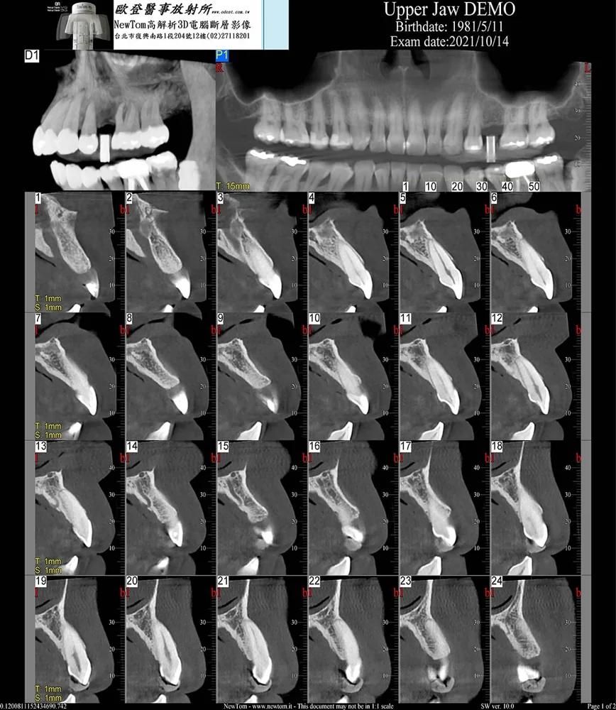Upper Jaw 斷層切面 1