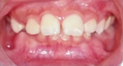 下顎後縮矯正前